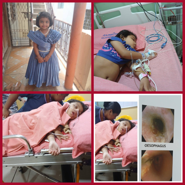 Child who ate harpic acid powder at Narayana School