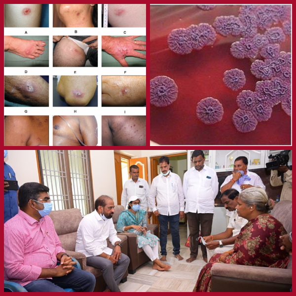 Rare disease discovered in Turkapalem